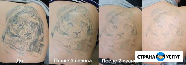 Удаление татуировок лазером Челябинск - изображение 1