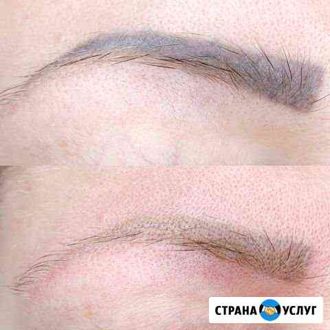 Удаление татуажа лазером и ремувером Сочи