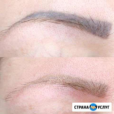 Удаление татуажа лазером и ремувером Сочи - изображение 1