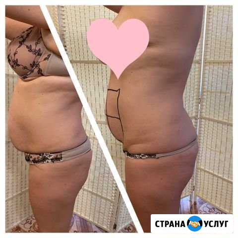 Liposonix Симферополь - изображение 1