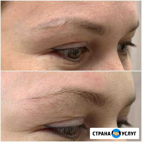 Удаление татуажа Ярославль - изображение 1
