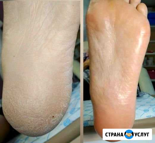 Аппаратный смарт педикюр Хабаровск - изображение 1