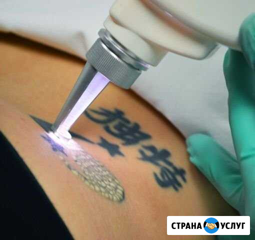 Удаление татуажа и татуировок лазером Бузулук - изображение 1