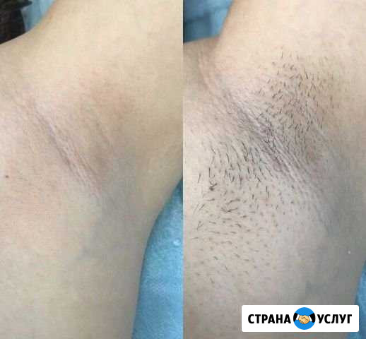 Шугаринг Краснодар - изображение 1