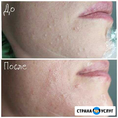 Чистка лица Белгород - изображение 1