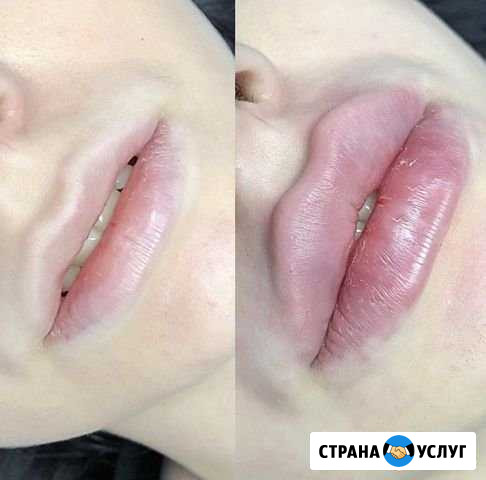 Увеличение губ Петропавловск-Камчатский - изображение 1