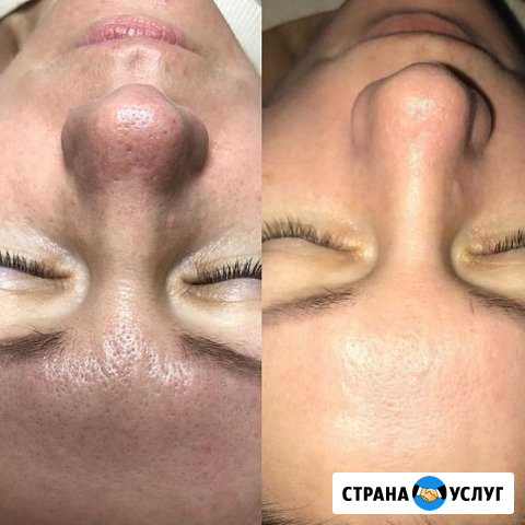 10-этапная чистка лица Оренбург - изображение 1