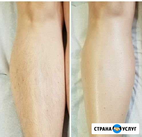 Электроэпиляция Ижевск - изображение 1
