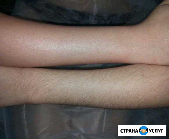 Депиляция Новосибирск - изображение 1