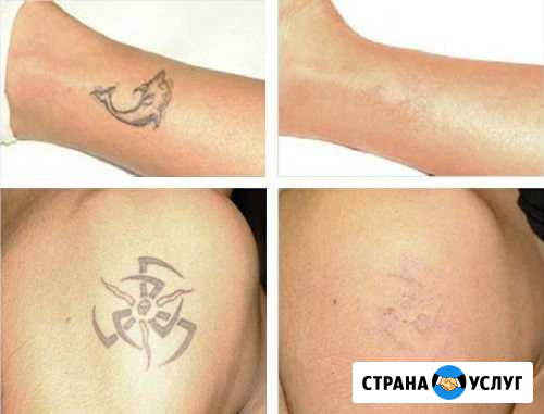 Удаление тату и пермоментного татуажа Елизово - изображение 1