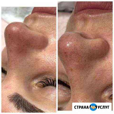 Чистка лица Краснодар