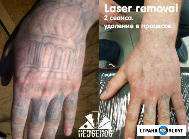 Лазерное удаление тату (перманентного макияжа) Ковров - изображение 1