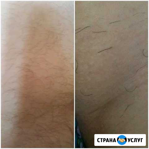 Электроэпиляция Уфа - изображение 1