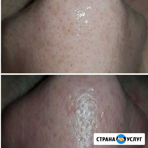 Уз чистка лица Оренбург - изображение 1