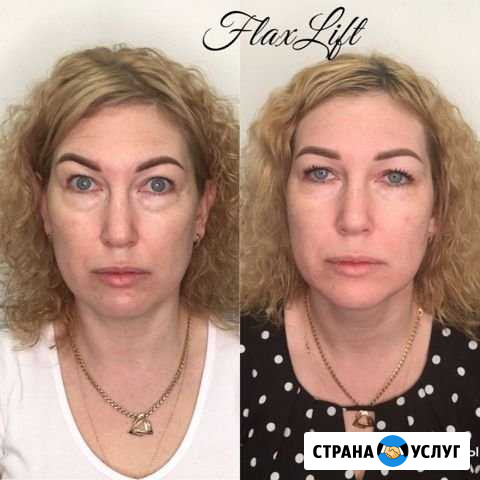 Лифтинг лица и шеи без уколов без фотошопа Воронеж - изображение 1