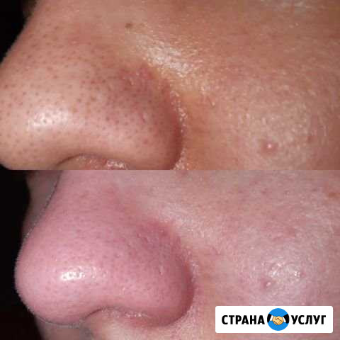 Чистка лица Сургут - изображение 1
