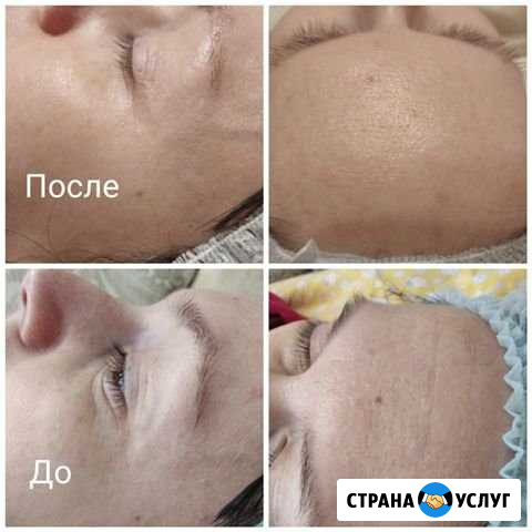 Ультразвуковая липосакция Ульяновск - изображение 1