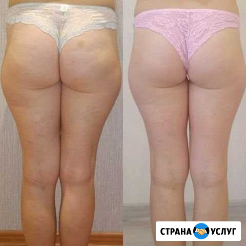 Антицеллюлитный массаж Пермь - изображение 1