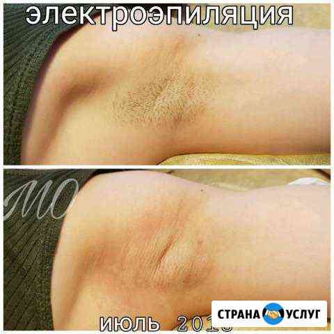 Электроэпиляция Пермь