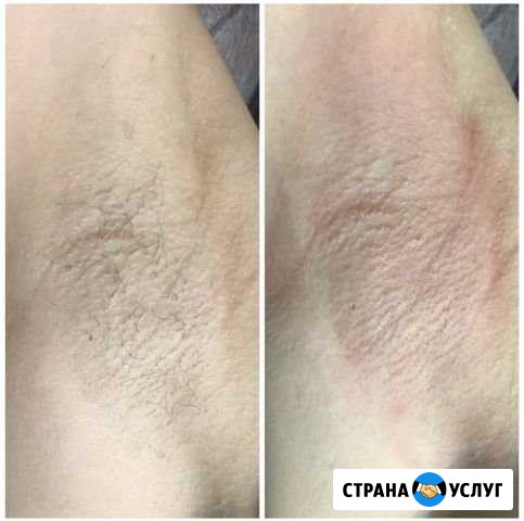 Депиляция Иркутск Иркутск - изображение 1