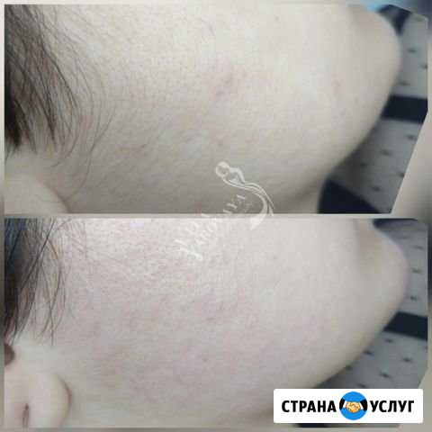 Электроэпиляция Белгород - изображение 1