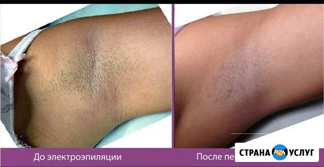 Электроэпиляция Магадан - изображение 1