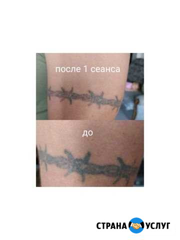 Удаление тату, татуажа Брянск - изображение 1
