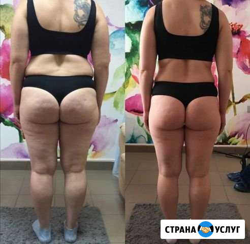 Lpg антицеллюлитный массаж, кавитация, rf лифтинг Нижний Тагил - изображение 1