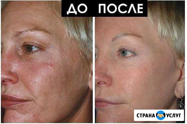 Омоложение и подтяжка кожи Барнаул - изображение 1