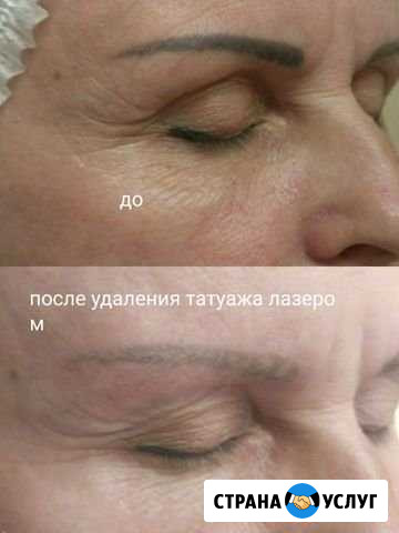 Удаление татуировки (татуажа) лазером Иваново - изображение 1