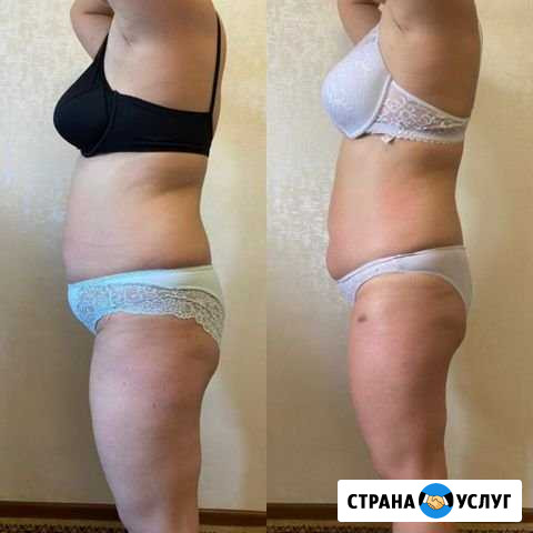 Вакуумный массаж Набережные Челны - изображение 1