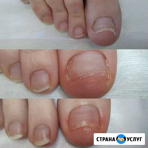 Педикюр медицинский Нижний Новгород - изображение 1