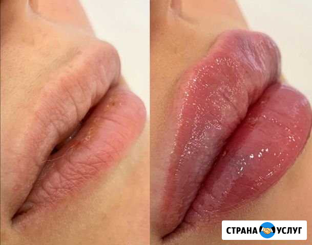 Лазерная эпиляция всех зон 4000 Реутов - изображение 1