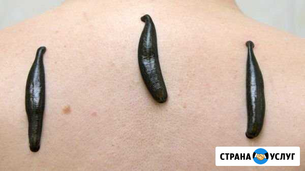 Купон на гирудотерапию Ногинск - изображение 1