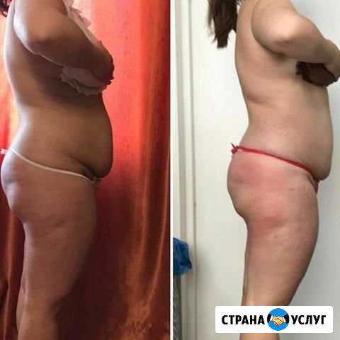 Лимфодренаж для уменьшения объемов Тольятти - изображение 1