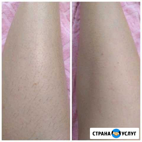 Шугаринг Лобня - изображение 1