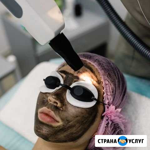 Карбоновый пилинг, удаление тату Казань - изображение 1