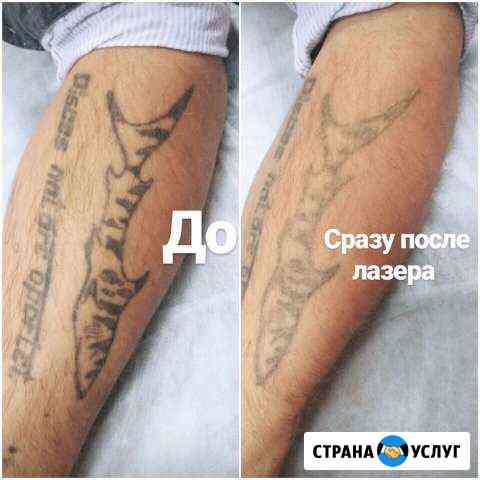 Лазерное удаление тату Екатеринбург