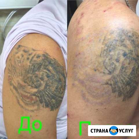 Удаление татуировок и татуажа Нижний Новгород - изображение 1