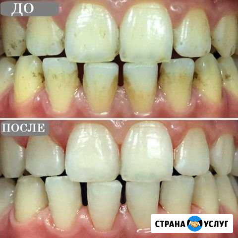 Профессиональная чистка зубов Грозный - изображение 1