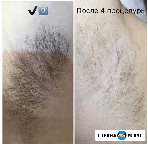 Электроэпиляция Махачкала - изображение 1