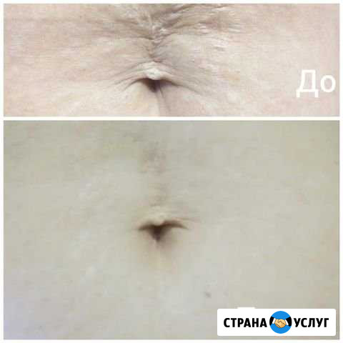 Холодная плазма лечение И омоложение кожи суперпре Ханты-Мансийск - изображение 1