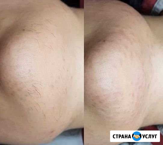 Электроэпиляция Белгород - изображение 1