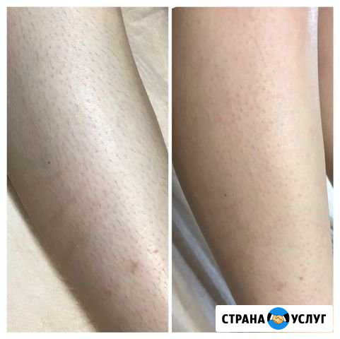 Шугаринг Астрахань - изображение 1