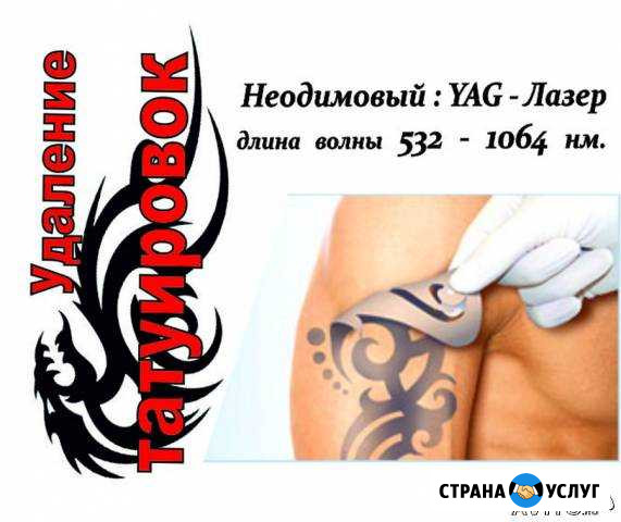 Удаление надоевшей Тату или старого Татуажa Пермь - изображение 1