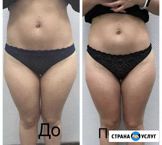 Антицеллюлитный массаж Рязань - изображение 1