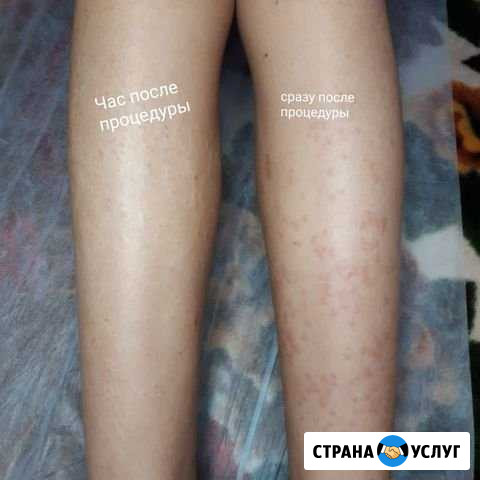 Электроэпиляция Курск - изображение 1