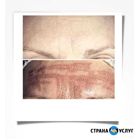 Уход за лицом, косметолог, жидкий лазер,плазма Москва - изображение 1
