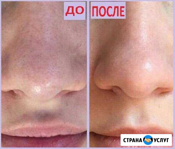 Ультразвуковая чистка лица Петропавловск-Камчатский - изображение 1