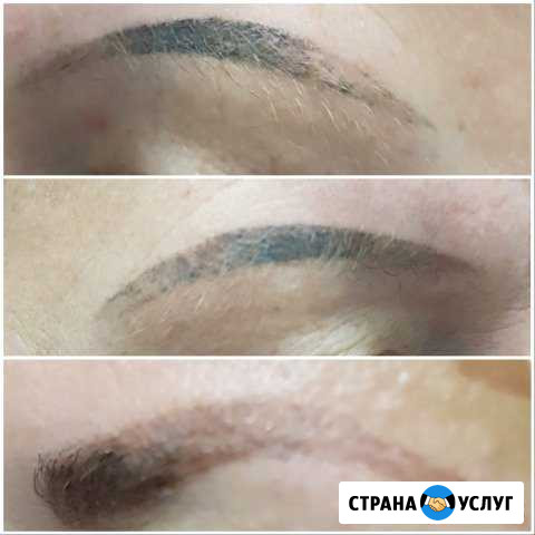 Удаление татуажа и татуировки неодимовым лазером Екатеринбург - изображение 1